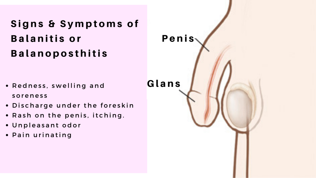 Signs & Symptoms of Balanitis
