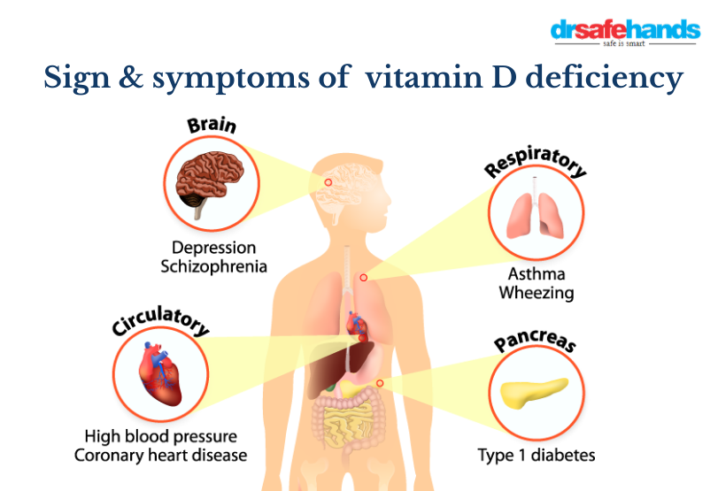 vitamin d deficiency rickets
