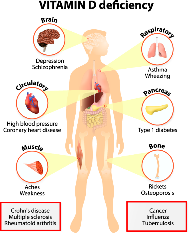 Signs and Symptoms of Vitamin D Deficiency | DrSafeHands