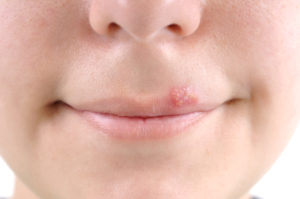 Herpes on lips