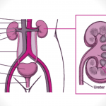 What is Urinary Tract Infection