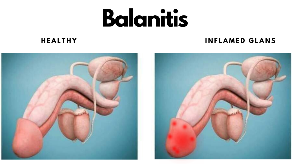 What is Balanitis