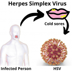 Herpes Simplex Virus Infection Circle