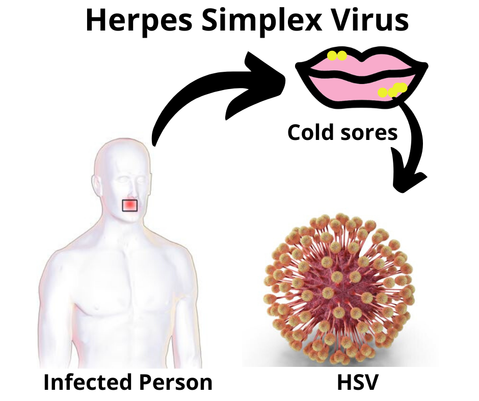 HSV Infection Circle