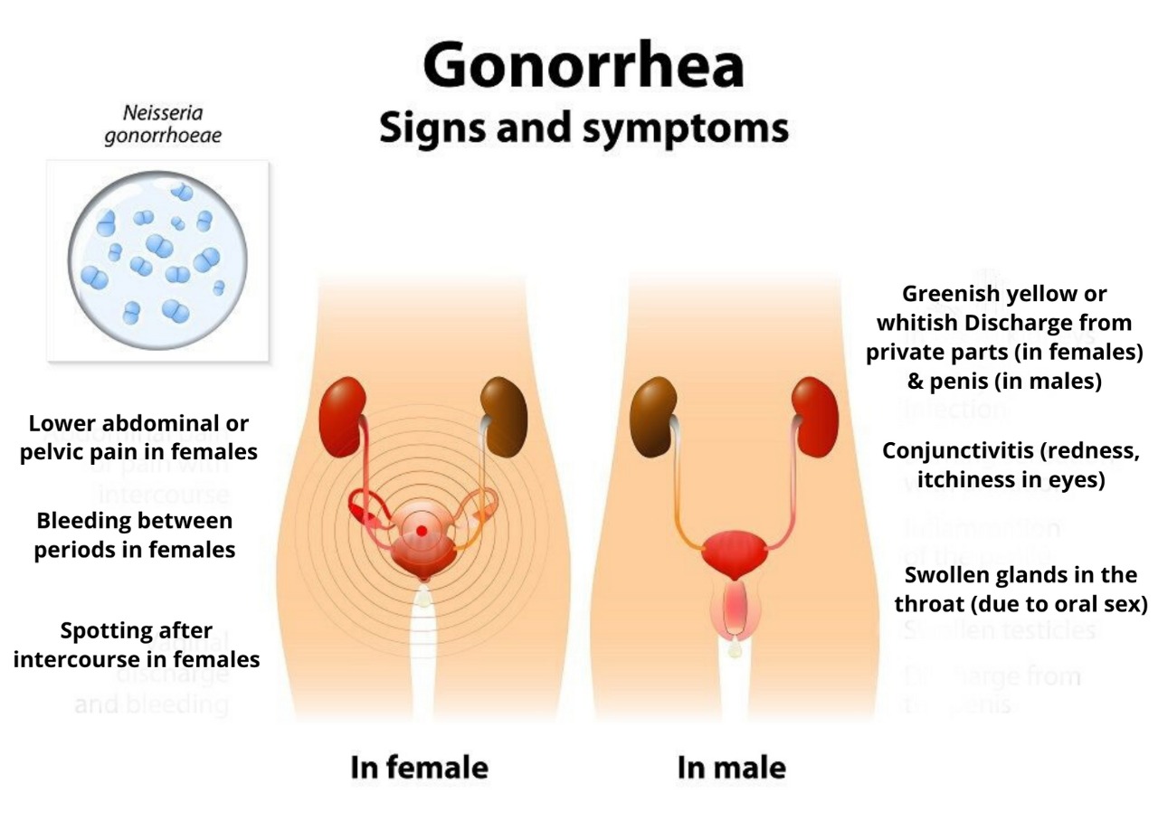 gonorrhea signs and symptoms image
